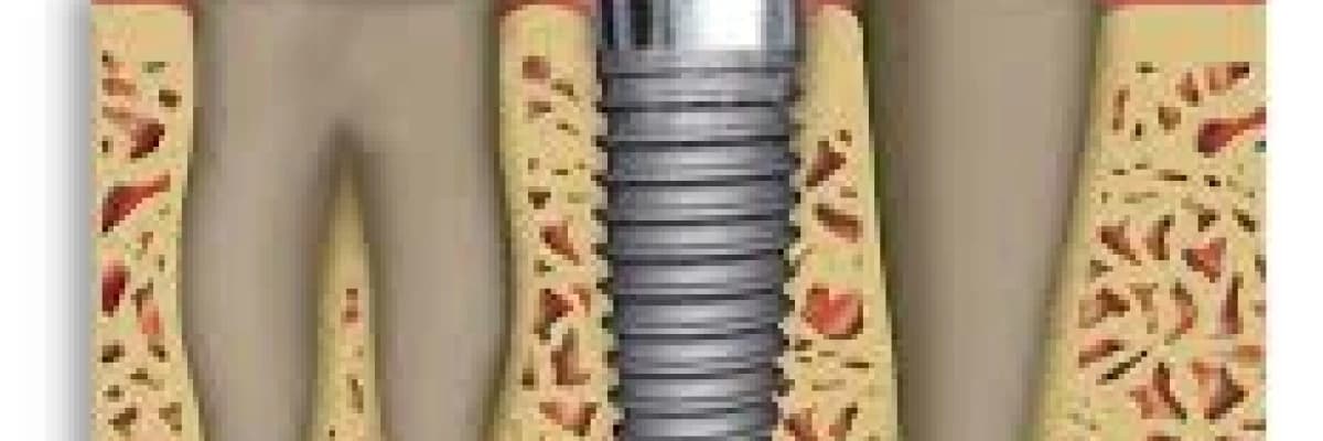 İmplant tedavisi ile ilgili sorularınıza cevaplar 1.bölüm...