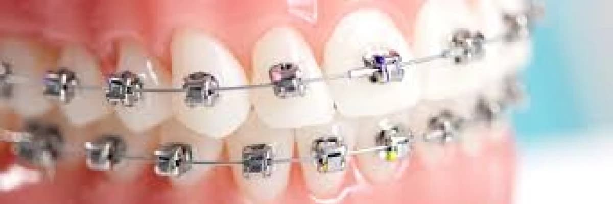 Ortodonti, diğer adıyla Tel Tedavisi Nasıl Yapılır?