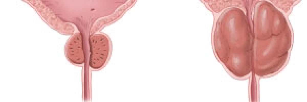 Prostat Biyopsisi Nedir?