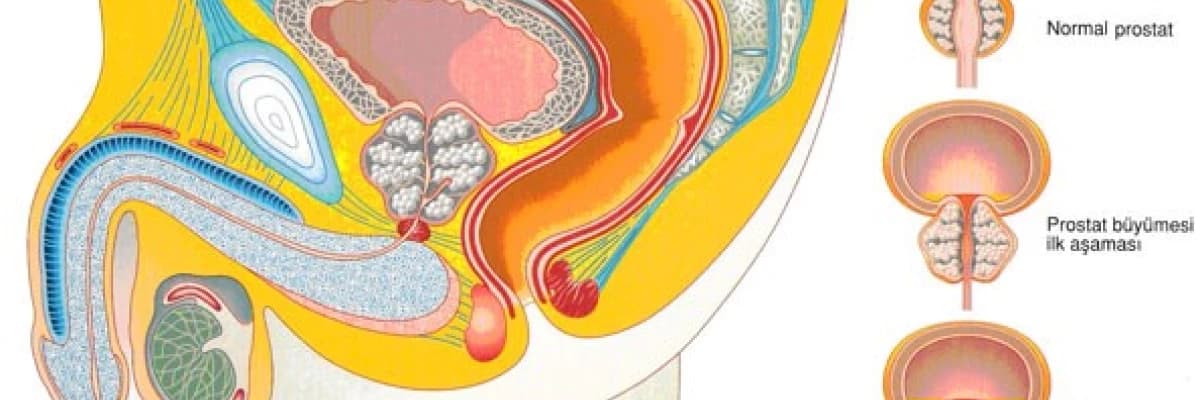 PROSTAT HAKKINDA ADIM ADIM BİLİNMESİ GEREKENLER