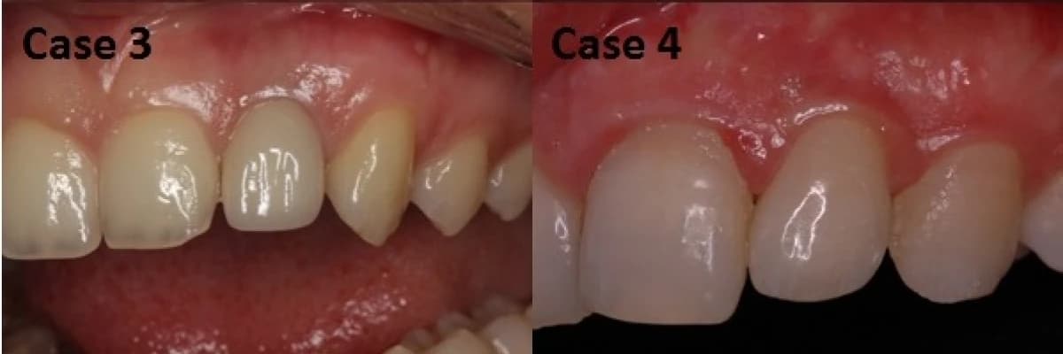 Hemen implantasyon nedir, nasıl yapılmaktadır?