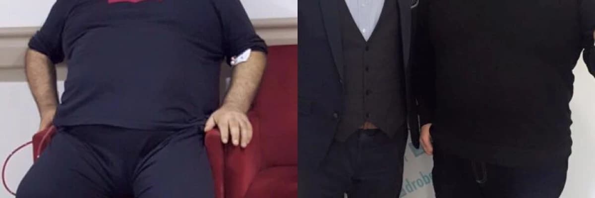 Tüp Mide Ameliyatı Nasıl Yapılır?