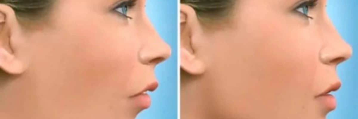 Çene rotasyonu ve diş sürmesi arasındaki ilişki