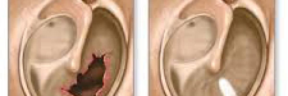 Kulak Zarı Onarılması (Timpanoplasti)