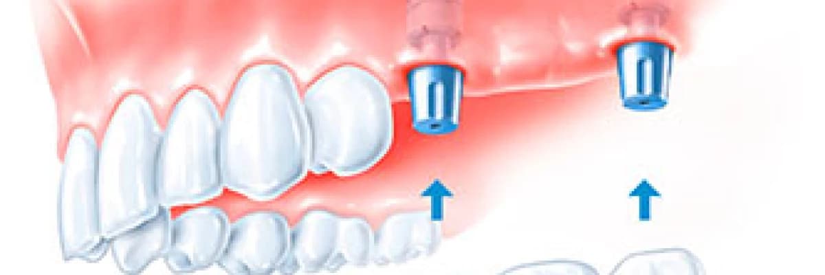 İmplant Tedavisi Hakkında Merak Edilenler!