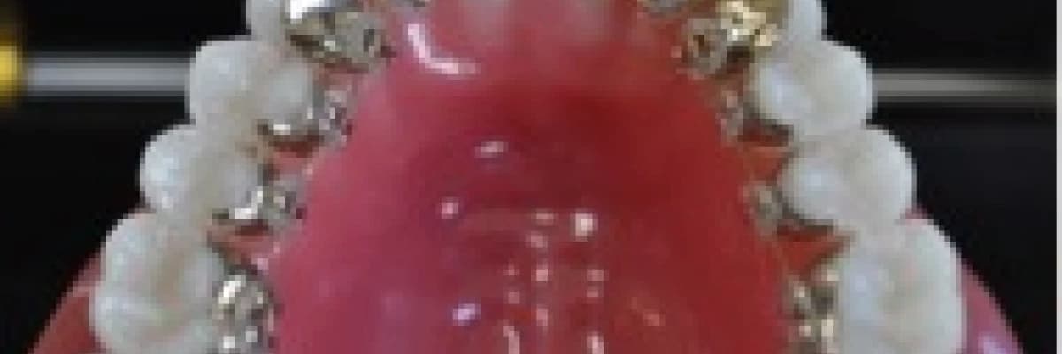 Lingual ortodonti: Tellerimi gören var mı?