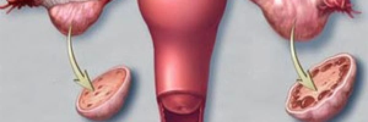 POLİKİSTİK OVER SENDROMU NEDİR?  (PCOS)