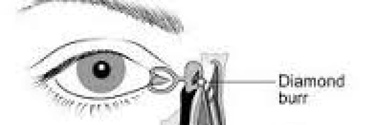 Lazerli Göz Yaşı Kanalı Açılması (Lazer DCR)