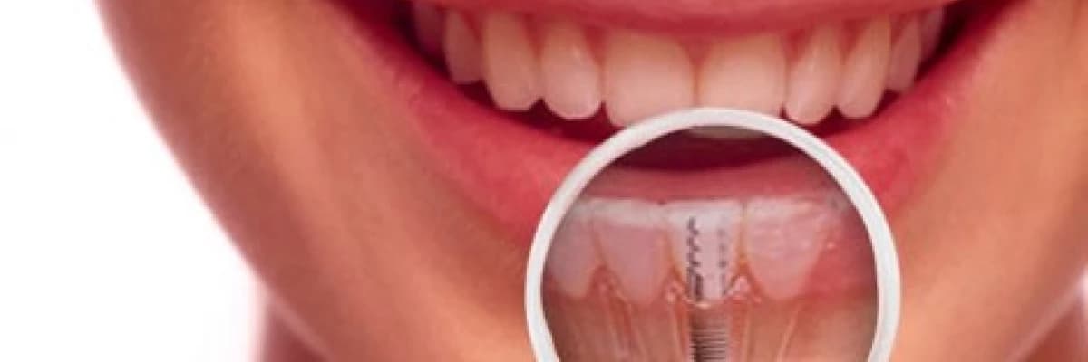 DENTAL (DİŞ ) İMPANTLAR NEDİR?