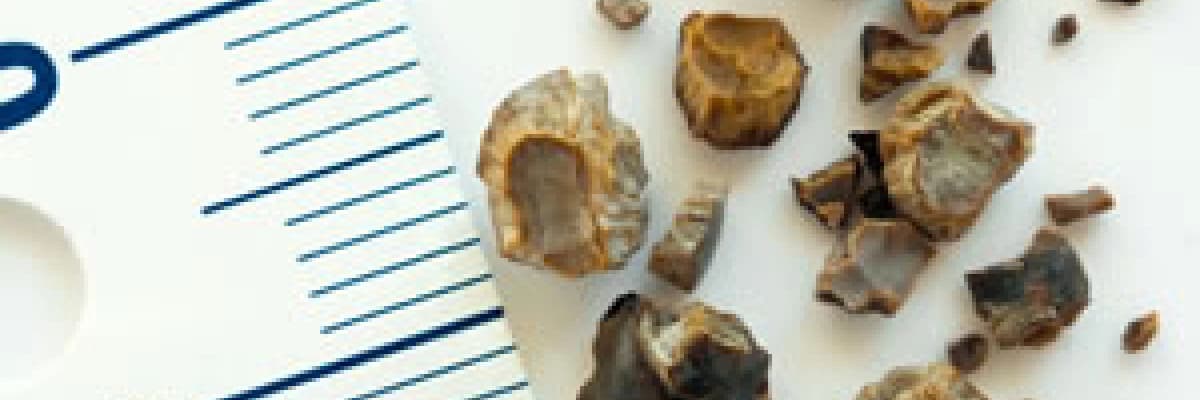 Böbrek ve Üreter Taşları