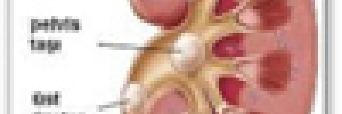 Taş hastalığı nedir? Oluşmasında etkili faktörler nelerdir?