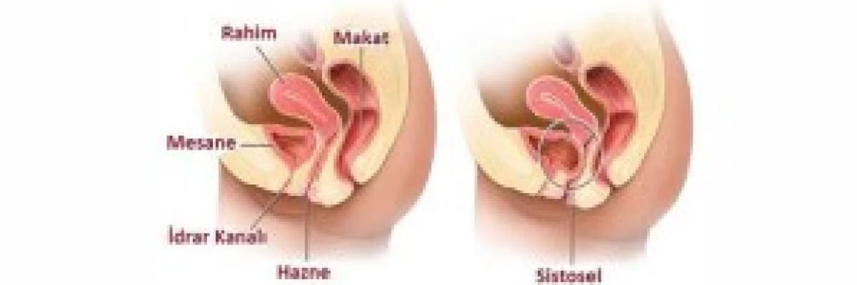 Genital Yol Anormallikleri