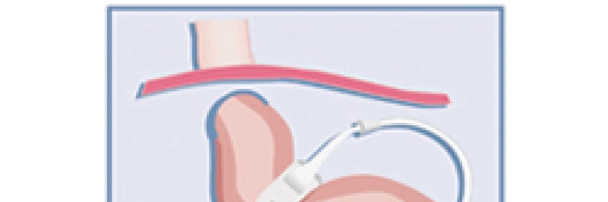 Mide Bandı Ameliyatı
