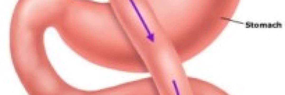 Mide by-bass Ameliyatı