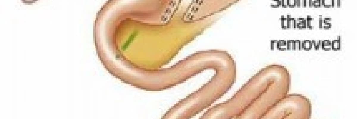 Tüp Mide Ameliyatı nasıl etki eder?