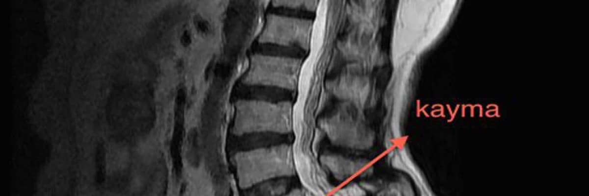 Bel Kayması (Spondilolistezis) Nedir ve Nasıl Oluşur?