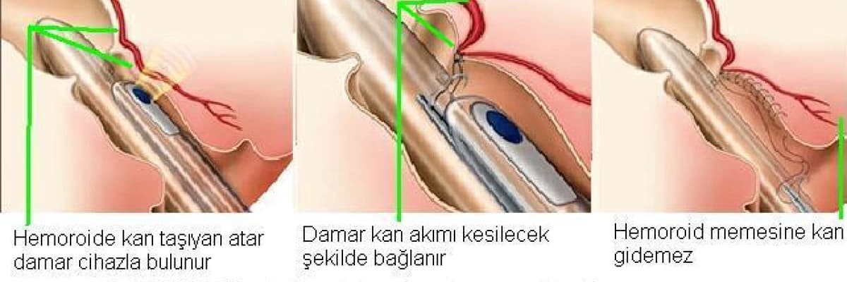 HEMOROİD HASTALIĞI VE HEMOROİD ARTER LİGASYONU  (ağrısız (kesme işlemi olmadan ) kanamasız tedavi  )