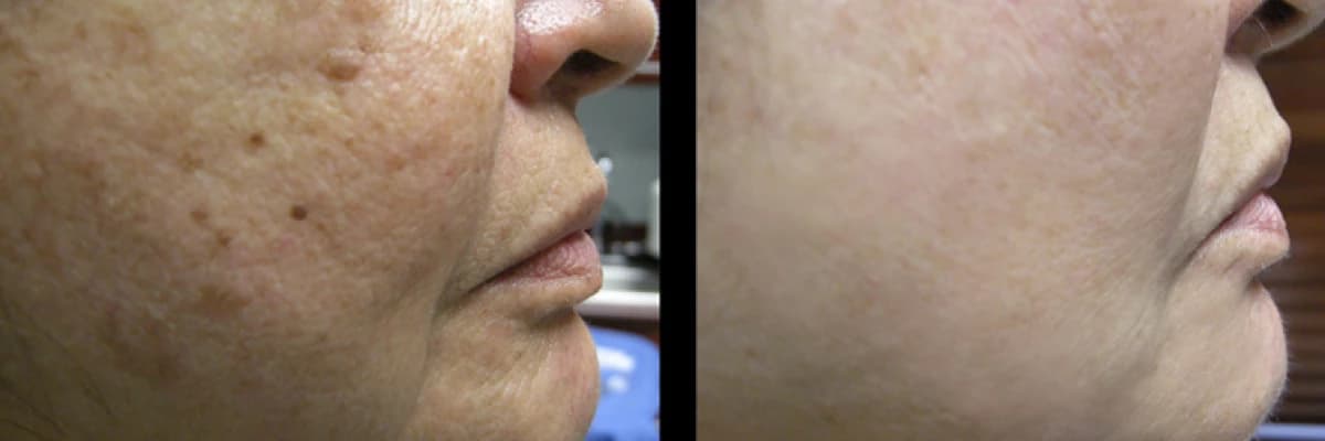 Prp ( trombositten zengin plazma ) nedir? Faydaları nelerdir? Nerede kullanılır? Ne kadar süre etkilidir?