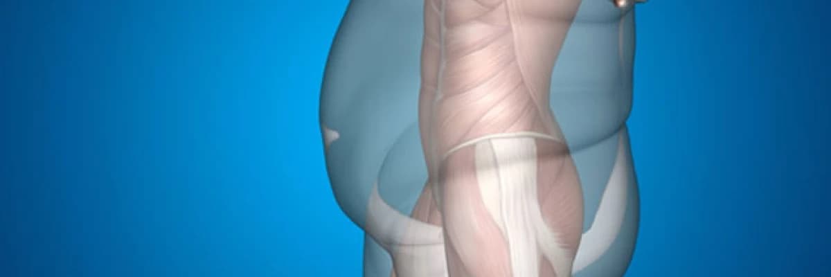 Obezite sonuçları ve obezite cerrahisinin faydaları: gastrik bypass (mide küçültme) ve sleeve gastrektomi (tüp mide)