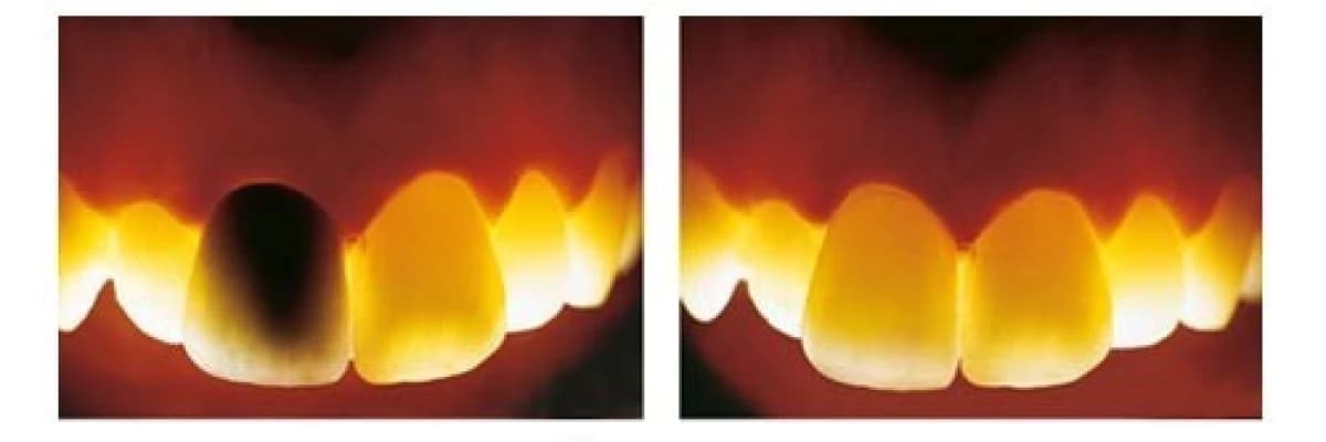 Zirkonyum ve Dişhekimliği