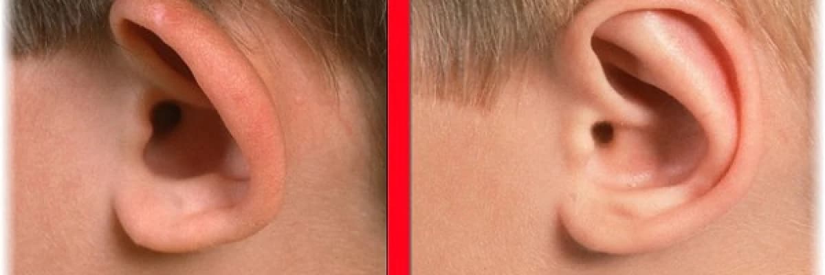 Kepçe Kulak Estetiği Hakkında Bilmeniz Gerekenler