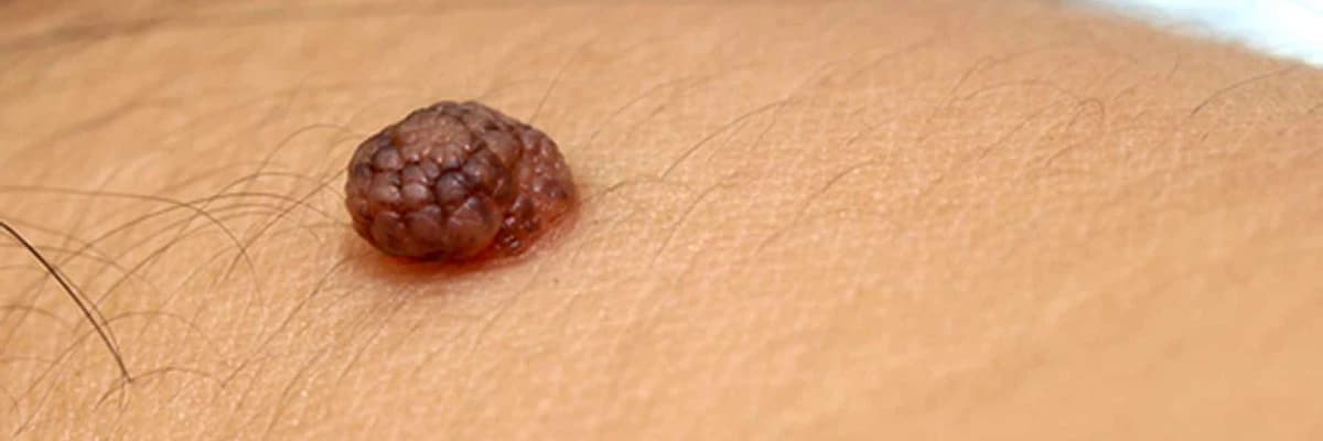 HANGİ BENLER ALINMALI?