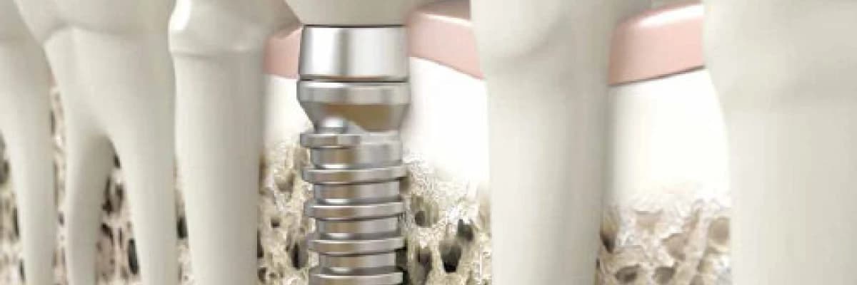 Fonksiyonel Yapay Diş Kökü̈