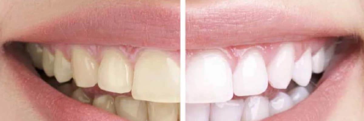 Diş Beyazlatmak İstiyorum