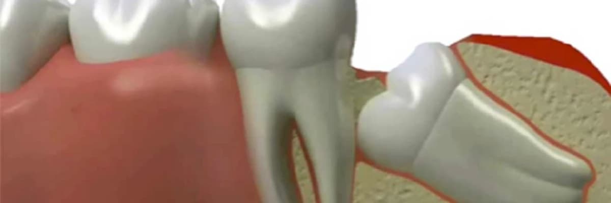 20 yaş dişleri neden çekilir , çekim sonrası neler yapılmalıdır