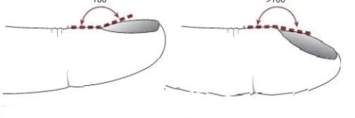 Clubbing (Çomak parmak)