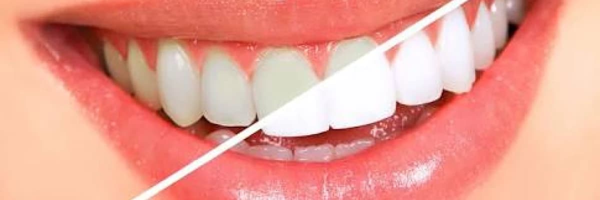 Bleaching (diş beyazlatma) işlemi