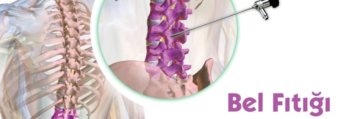 Bel Fıtığında Endoskopik Yöntem