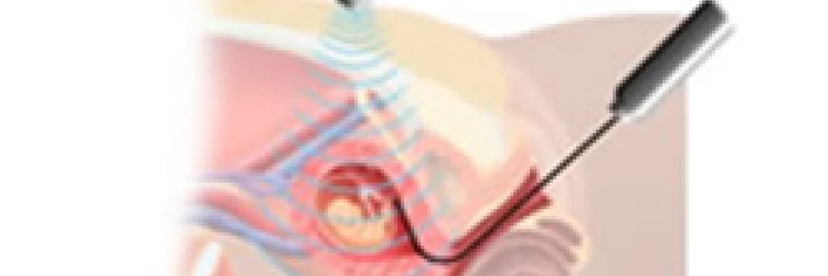 Koryon vilüs örneklemesi, CVS