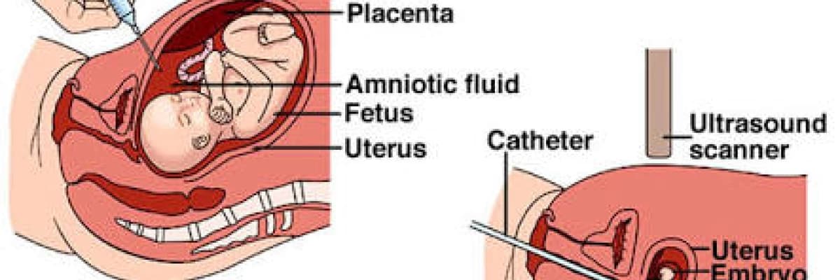 Amniyosentez nedir? Gebeliğin kaçıncı haftası yapılır?