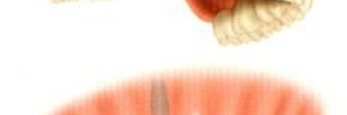 İmplant uygulamasının aşamaları