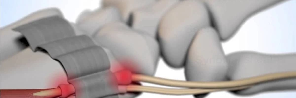 Başparmağın hareketleri kısıtlayan hastalık. De Quervain hastalığı