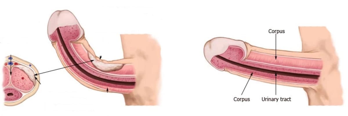 Penis eğiriliği tedavisi mümkün olan bir durumdur