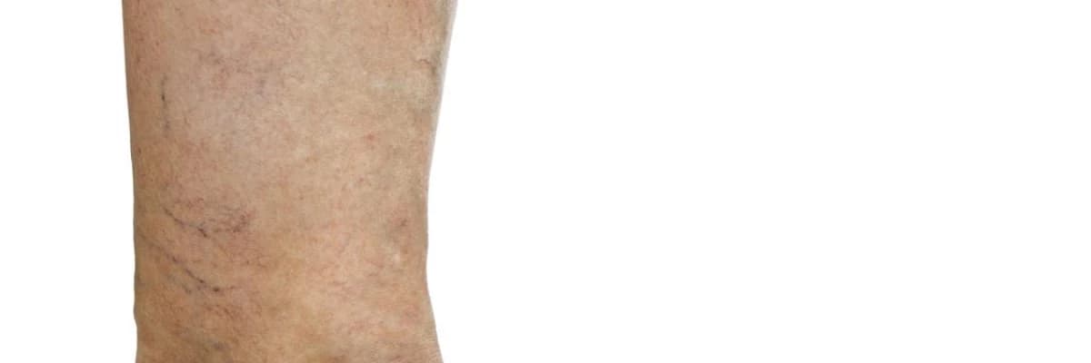 Erkeklerde Varis Olur mu?