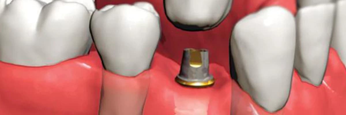 İMPLANTOLOJİ ve ÇENE İMPLANTLARI hakkında sık sorulan sorular