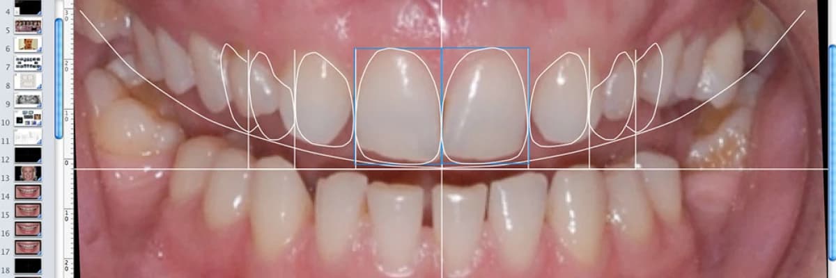 Kişiye Özel Gülüş Tasarımı