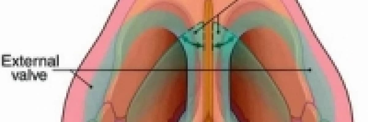 Burun Yan Duvarı Zayıflığı (Nazal Valv Darlığı)