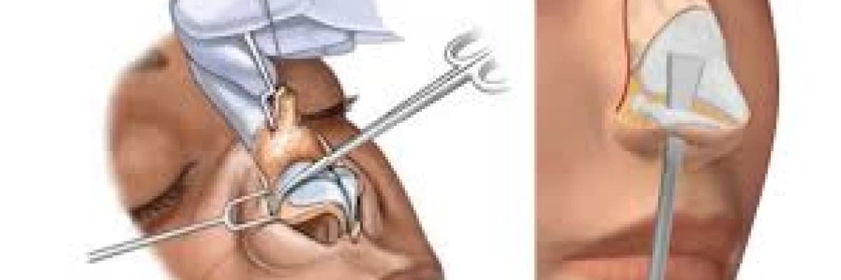 RİNOPLASTİ (BURUN ESTETİĞİ) AMELİYATINDAN SONRA DİKKAT EDİLMESİ GEREKLİ NOKTALAR