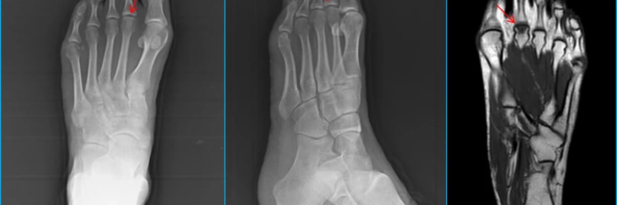 Freiberg Hastalığı