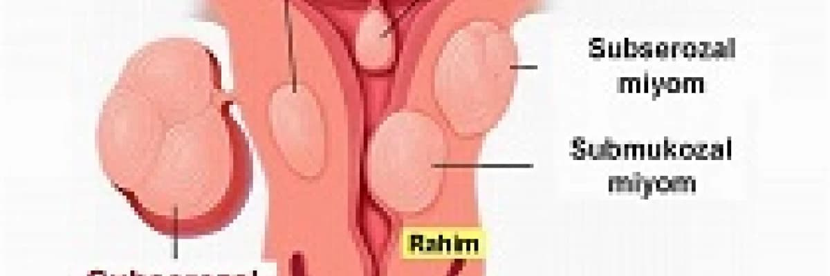 Miyomlar ve infertilite