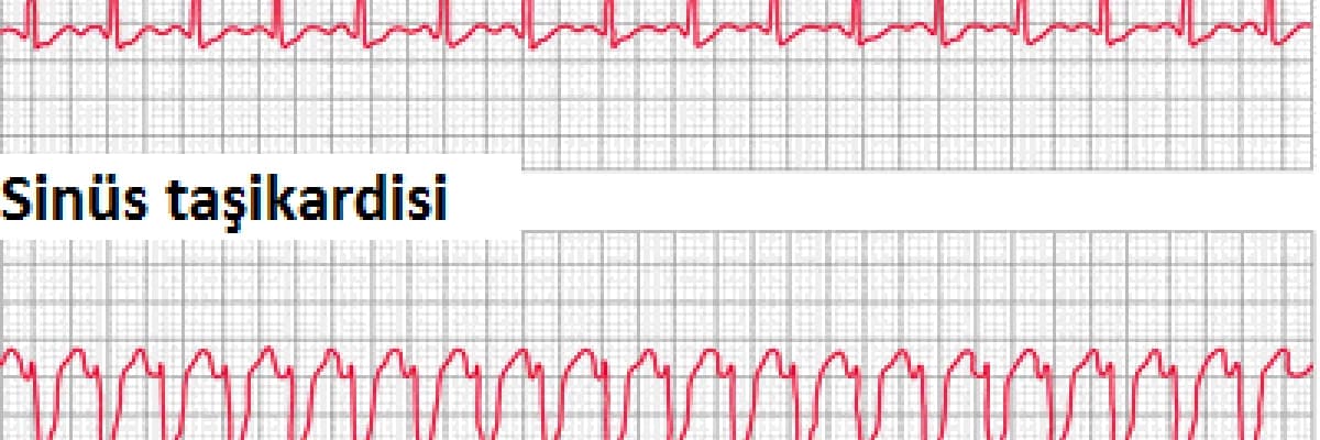 Çocuklarda çarpıntı olur mu?