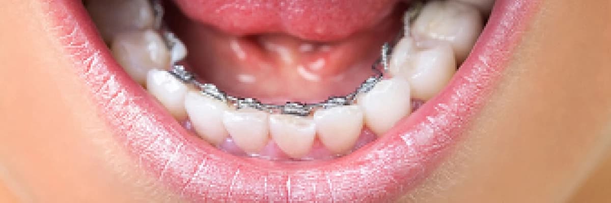 İçten diş teli tedavisi