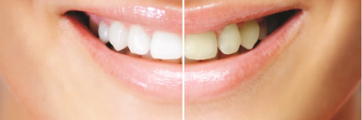 Diş Beyazlatma ne demektir