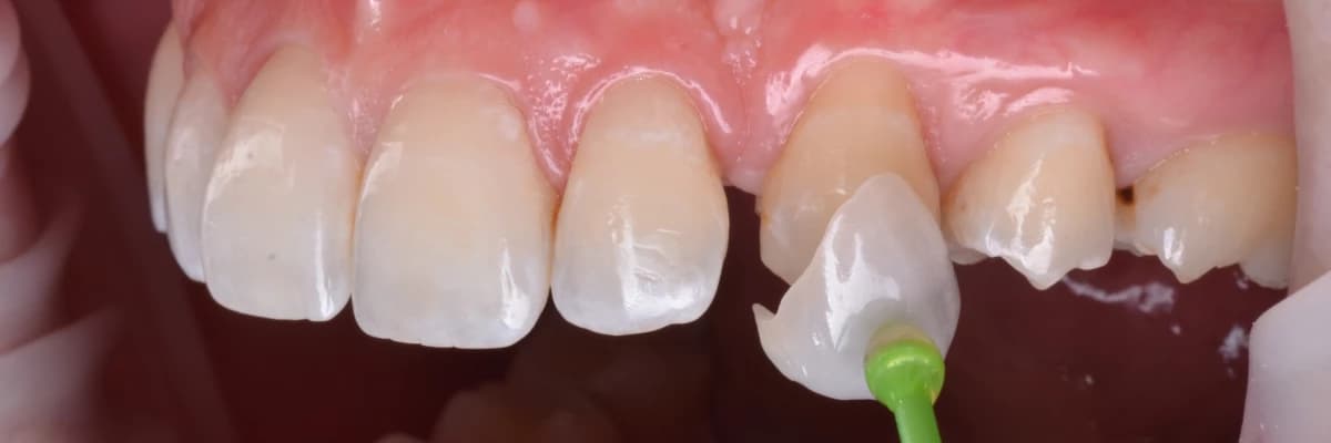 Porselen laminate kaplamalar