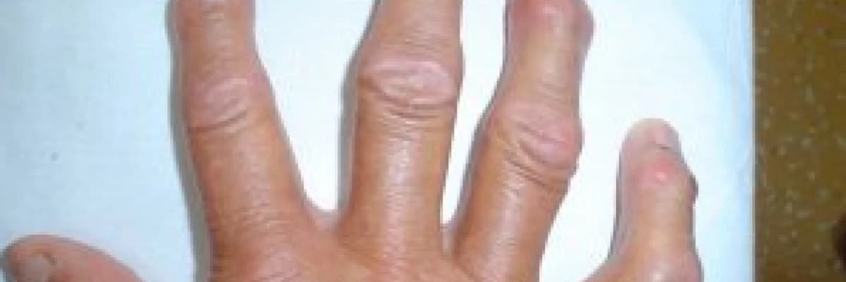 OSTEOARTRİT; KİREÇLENME MECBURİ BİR KADER MİDİR?