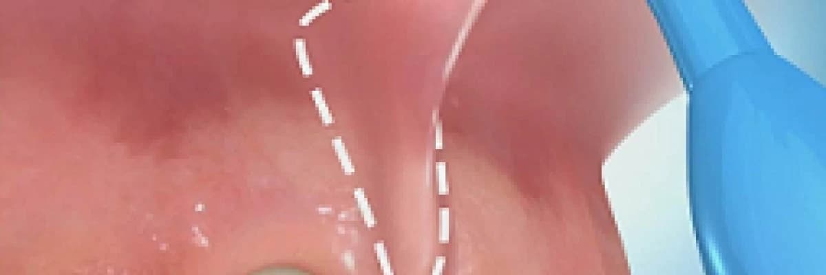 Frenektomi, Fiberotomi ve Gingivoplasti